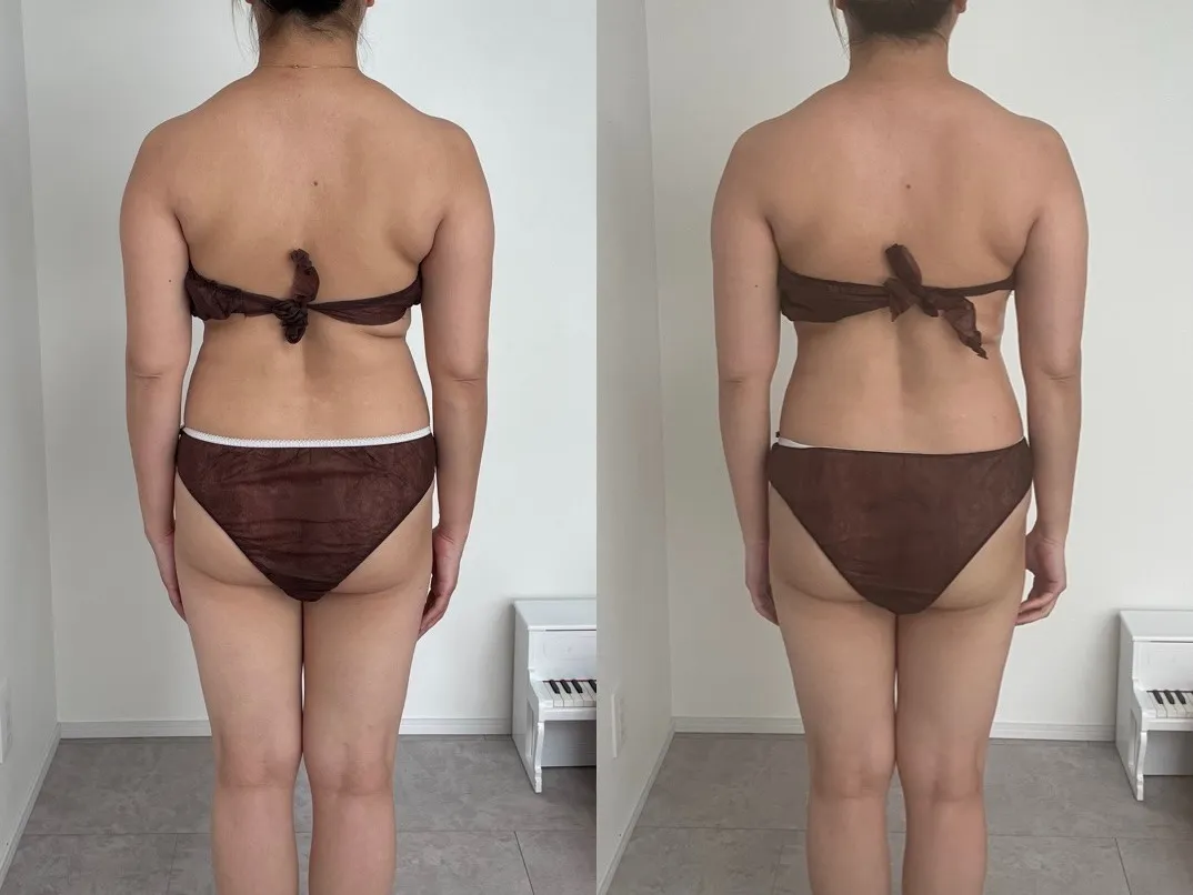 微弱電流トリートメント/ハンドセラピスの効果は!?